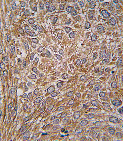 Formalin-fixed and paraffin-embedded human lung carcinoma tissue reacted with GIT1 Antibody (Y510) , which was peroxidase-conjugated to the secondary antibody, followed by DAB staining. This data demonstrates the use of this antibody for immunohistochemistry; clinical relevance has not been evaluated.