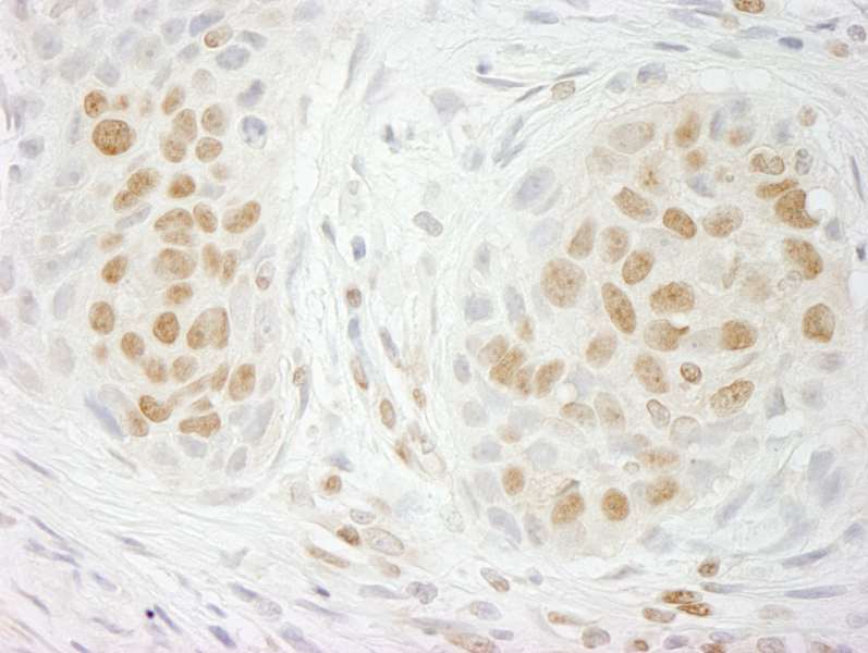 Detection of Human GIT2 Immunohistochemistry. Sample: FFPE section of human lung carcinoma. Antibody: Affinity purified rabbit anti-GIT2 used at a dilution of 1:500.