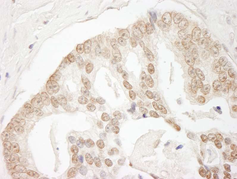 Detection of Human GIT2 by Immunohistochemistry. Sample: FFPE section of human prostate carcinoma. Antibody: Affinity purified rabbit anti-GIT2 used at a dilution of 1:1000 (1 Detection: DAB.