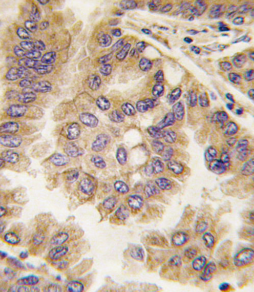 Formalin-fixed and paraffin-embedded human lung carcinoma tissue reacted with GJA5 antibody , which was peroxidase-conjugated to the secondary antibody, followed by DAB staining. This data demonstrates the use of this antibody for immunohistochemistry; clinical relevance has not been evaluated.