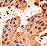 Formalin-fixed and paraffin-embedded human cancer tissue reacted with the primary antibody, which was peroxidase-conjugated to the secondary antibody, followed by DAB staining. This data demonstrates the use of this antibody for immunohistochemistry; clinical relevance has not been evaluated. BC = breast carcinoma; HC = hepatocarcinoma.