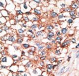 Formalin-fixed and paraffin-embedded human cancer tissue reacted with the primary antibody, which was peroxidase-conjugated to the secondary antibody, followed by AEC staining. This data demonstrates the use of this antibody for immunohistochemistry; clinical relevance has not been evaluated. BC = breast carcinoma; HC = hepatocarcinoma.