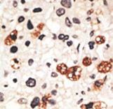 Formalin-fixed and paraffin-embedded human cancer tissue reacted with the primary antibody, which was peroxidase-conjugated to the secondary antibody, followed by DAB staining. This data demonstrates the use of this antibody for immunohistochemistry; clinical relevance has not been evaluated. BC = breast carcinoma; HC = hepatocarcinoma.
