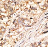 Formalin-fixed and paraffin-embedded human cancer tissue reacted with the primary antibody, which was peroxidase-conjugated to the secondary antibody, followed by DAB staining. This data demonstrates the use of this antibody for immunohistochemistry; clinical relevance has not been evaluated. BC = breast carcinoma; HC = hepatocarcinoma.