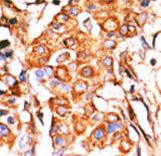 Formalin-fixed and paraffin-embedded human cancer tissue reacted with the primary antibody, which was peroxidase-conjugated to the secondary antibody, followed by AEC staining. This data demonstrates the use of this antibody for immunohistochemistry; clinical relevance has not been evaluated. BC = breast carcinoma; HC = hepatocarcinoma.