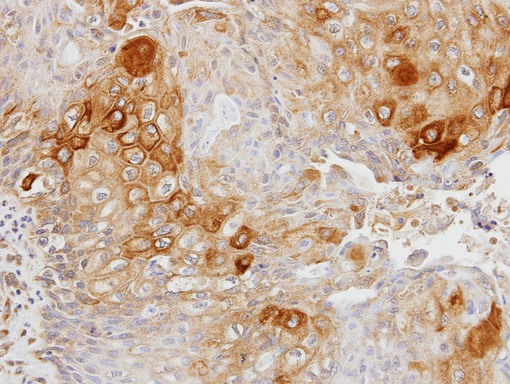 IHC of paraffin-embedded OVCA xenograft using Glycerol kinase 2 antibody at 1:100 dilution.