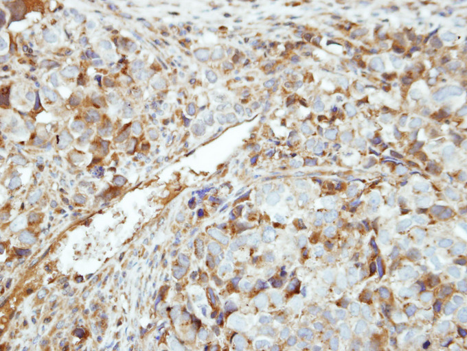 IHC of paraffin-embedded CL1-0 xenograft using GK5 antibody at 1:500 dilution.