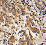 GKAP1 Antibody immunohistochemistry of formalin-fixed and paraffin-embedded human cervix carcinoma followed by peroxidase-conjugated secondary antibody and DAB staining.