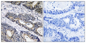 IHC of paraffin-embedded human colon carcinoma, using GLB1L3 Antibody. The picture on the right is treated with the synthesized peptide.