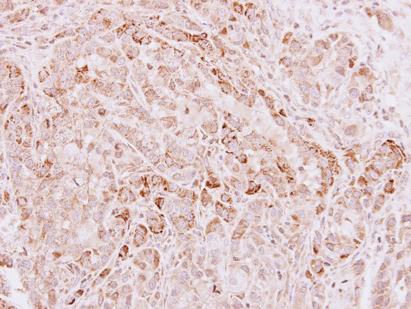 IHC of paraffin-embedded A549 xenograft using Glycine dehydrogenase antibody at 1:500 dilution.