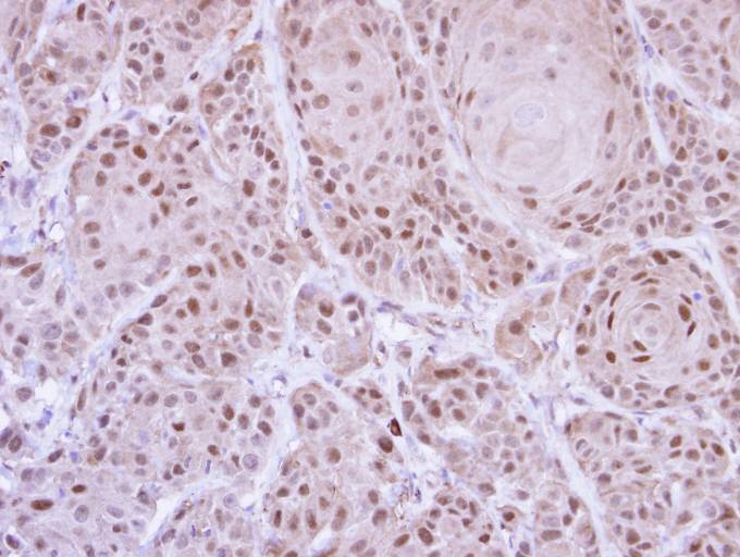 IHC of paraffin-embedded Cal27 xenograft using GLE1 antibody at 1:500 dilution.