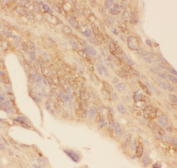 Gli1 antibody IHC-paraffin: Human Intestinal Cancer Tissue.