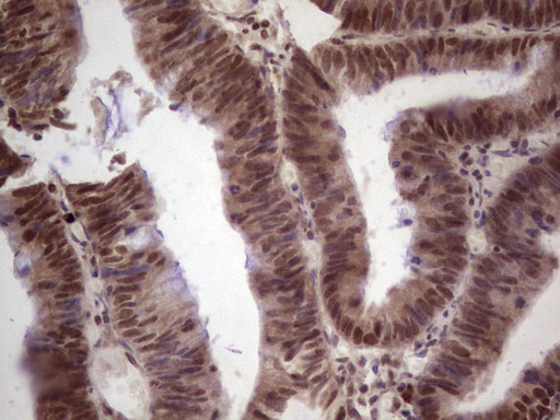 IHC of paraffin-embedded Adenocarcinoma of Human colon tissue using anti-GLI4 mouse monoclonal antibody. (Heat-induced epitope retrieval by 1 mM EDTA in 10mM Tris, pH8.5, 120°C for 3min).