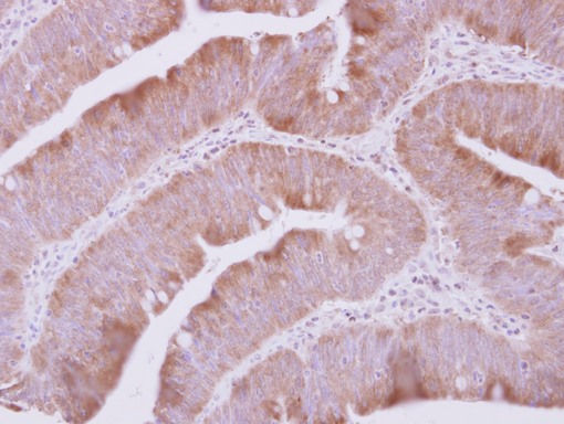 IHC of paraffin-embedded Colon ca, using QARS antibody at 1:500 dilution.