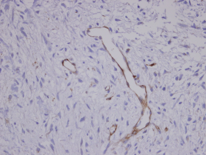IHC of paraffin-embedded Sarcoma meta to brain Blood Vessel using CORO1C antibody at 1:100 dilution.