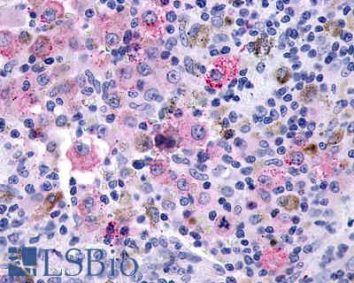 Anti-GLP2R / Glp-2 antibody IHC of human Skin, Melanoma. Immunohistochemistry of formalin-fixed, paraffin-embedded tissue after heat-induced antigen retrieval.