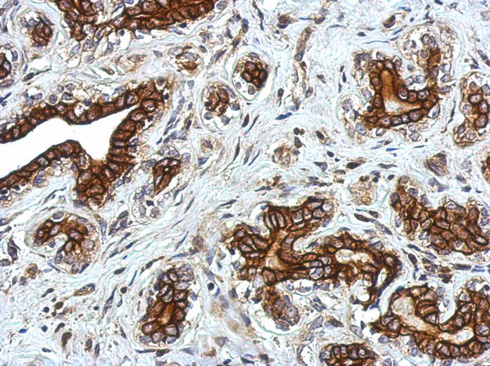 IHC of paraffin-embedded Breast ca using Glycine Receptor alpha 2 antibody at 1:750 dilution.