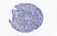 Immunohistochemical staining with anti-CORO1C antibody in breast cancer tissue at 1:100 dilution.