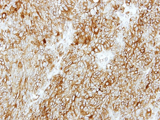 IHC of paraffin-embedded DLD1 xenograft using GMDS antibody at 1:500 dilution.