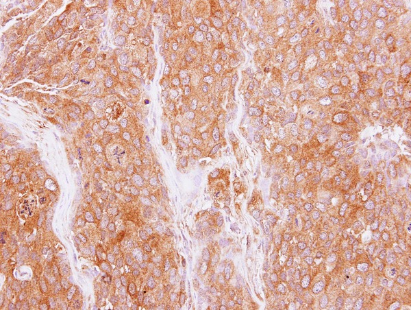 IHC of paraffin-embedded BT474 xenograft using GMF beta antibody at 1:500 dilution.
