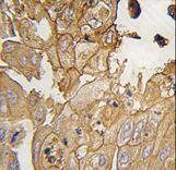 Formalin-fixed and paraffin-embedded human lung carcinoma tissue reacted with GMFG antibody , which was peroxidase-conjugated to the secondary antibody, followed by DAB staining. This data demonstrates the use of this antibody for immunohistochemistry; clinical relevance has not been evaluated.