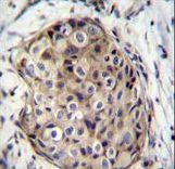GMPR Antibody immunohistochemistry of formalin-fixed and paraffin-embedded human breast carcinoma followed by peroxidase-conjugated secondary antibody and DAB staining.