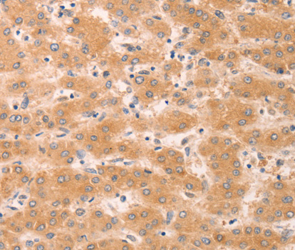 Immunohistochemistry of paraffin-embedded human liver cancer tissue, using GNA11 antibody.