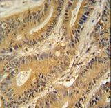 GNAT3 antibody immunohistochemistry of formalin-fixed and paraffin-embedded human colon carcinoma followed by peroxidase-conjugated secondary antibody and DAB staining.