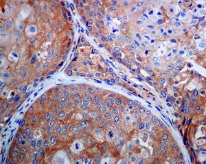 IHC of paraffin-embedded human cervical carcinoma tissue using anti-RACK1 antibody.