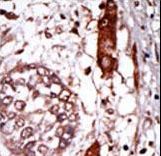 Formalin-fixed and paraffin-embedded human cancer tissue reacted with the primary antibody, which was peroxidase-conjugated to the secondary antibody, followed by AEC staining. This data demonstrates the use of this antibody for immunohistochemistry; clinical relevance has not been evaluated. BC = breast carcinoma; HC = hepatocarcinoma.
