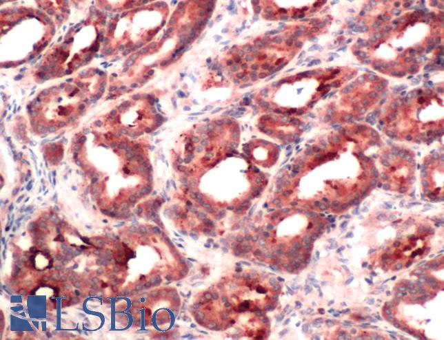 Immunohistochemistry of Human Prostate Carcinoma stained with anti-RACK-1 antibody