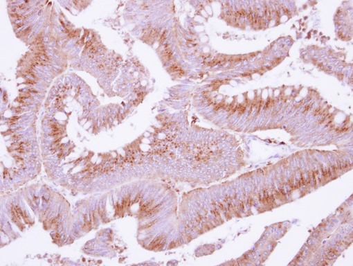 IHC of paraffin-embedded Colon ca, using COX15 antibody at 1:250 dilution.
