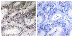 IHC of paraffin-embedded human colon carcinoma tissue, using COX19 Antibody. The picture on the right is treated with the synthesized peptide.