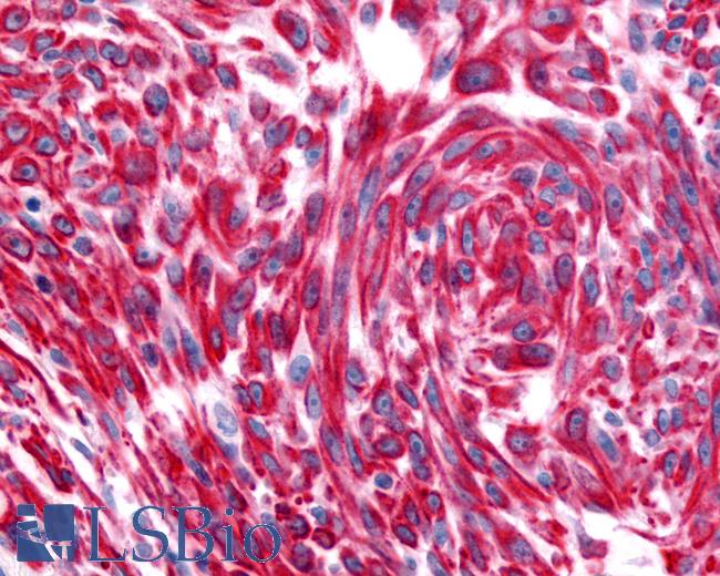 Anti-CHRM2 / M2 antibody IHC of human Skin, Melanoma. Immunohistochemistry of formalin-fixed, paraffin-embedded tissue after heat-induced antigen retrieval.