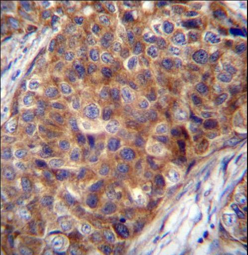 COX7A2L Antibody immunohistochemistry of formalin-fixed and paraffin-embedded human breast carcinoma followed by peroxidase-conjugated secondary antibody and DAB staining.