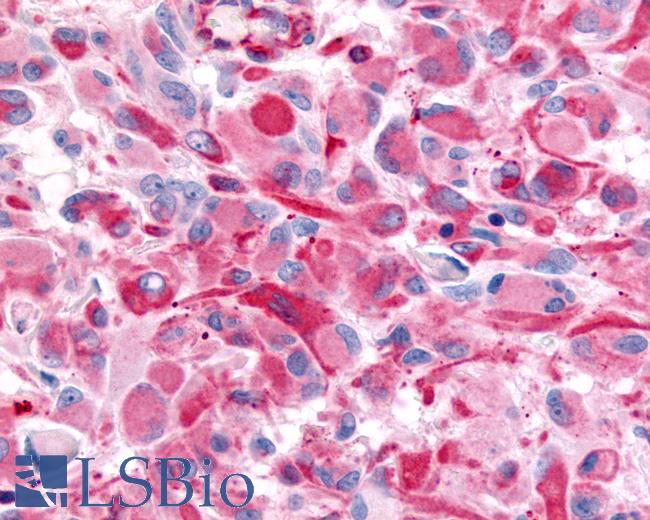 Anti-CHRM2 / M2 antibody IHC of human Brain, Glioblastoma. Immunohistochemistry of formalin-fixed, paraffin-embedded tissue after heat-induced antigen retrieval.