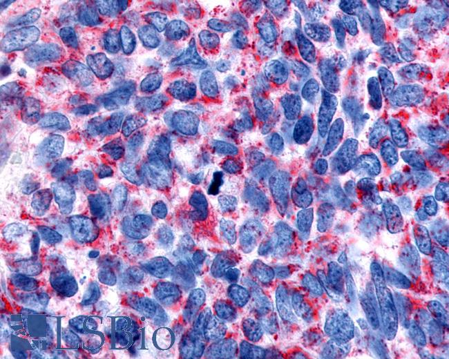 Anti-CHRM2 / M2 antibody IHC of human Lung, Small Cell Carcinoma. Immunohistochemistry of formalin-fixed, paraffin-embedded tissue after heat-induced antigen retrieval.