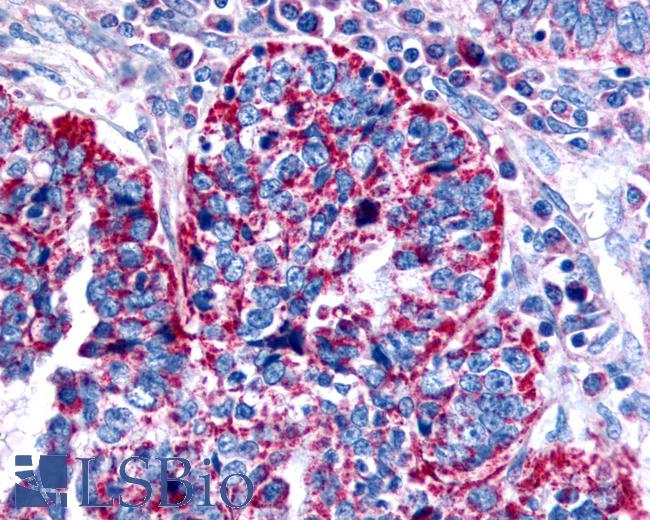 Anti-CHRM2 / M2 antibody IHC of human Ovary, Carcinoma. Immunohistochemistry of formalin-fixed, paraffin-embedded tissue after heat-induced antigen retrieval.
