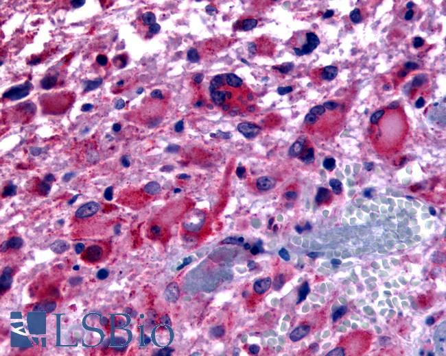 Anti-CHRM2 / M2 antibody IHC of human Brain, Glioblastoma. Immunohistochemistry of formalin-fixed, paraffin-embedded tissue after heat-induced antigen retrieval.
