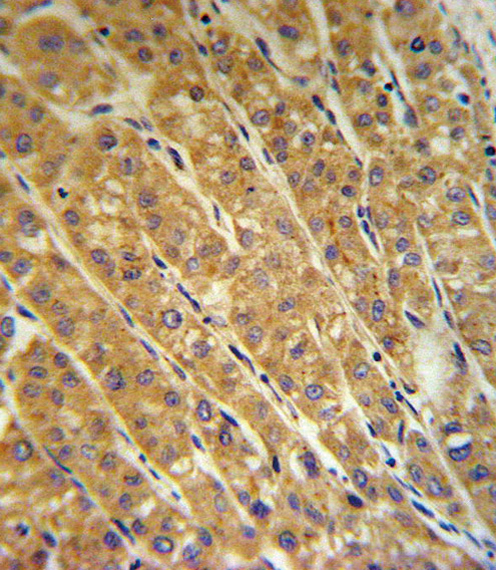 CP Antibody IHC of formalin-fixed and paraffin-embedded human hepatocarcinoma followed by peroxidase-conjugated secondary antibody and DAB staining.