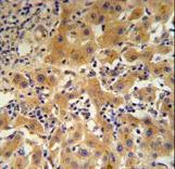 CP Antibody IHC of formalin-fixed and paraffin-embedded human hepatocarcinoma followed by peroxidase-conjugated secondary antibody and DAB staining.