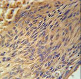 CPEB4 Antibody immunohistochemistry of formalin-fixed and paraffin-embedded human lung carcinoma followed by peroxidase-conjugated secondary antibody and DAB staining.