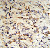 CPN2 Antibody (RB18703) IHC of formalin-fixed and paraffin-embedded human breast carcinoma tissue followed by peroxidase-conjugated secondary antibody and DAB staining.