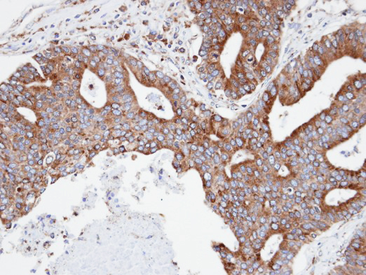 IHC of paraffin-embedded endo mitral OVCA using CPNE3 antibody at 1:100 dilution.