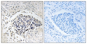 IHC of paraffin-embedded human lung carcinoma tissue, using CPNE8 Antibody. The picture on the right is treated with the synthesized peptide.