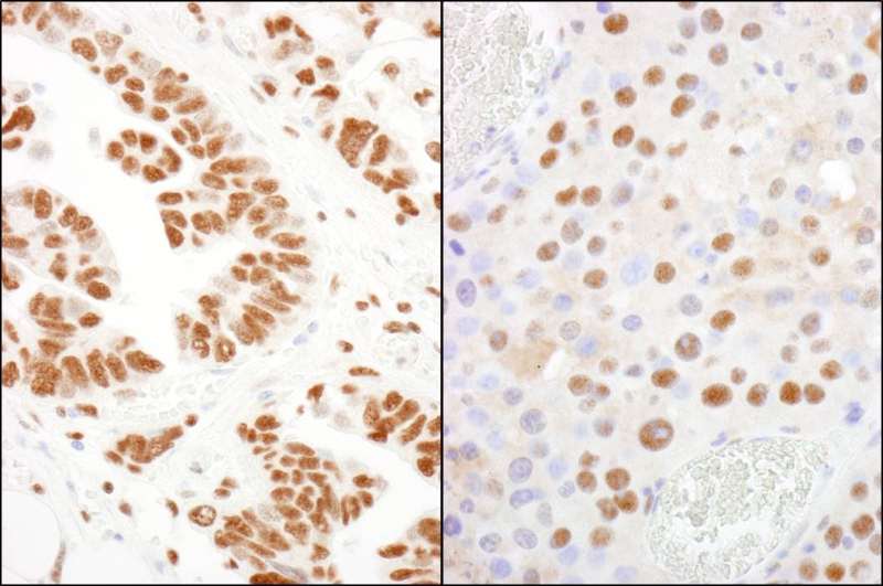 Detection of Human and Mouse CPSF160 by Immunohistochemistry. Sample: FFPE section of human ovarian carcinoma (left) and mouse renal cell carcinoma (right). Antibody: Affinity purified rabbit anti-CPSF160 used at a dilution of 1:200 (1 ug/ml). Detection: DAB.
