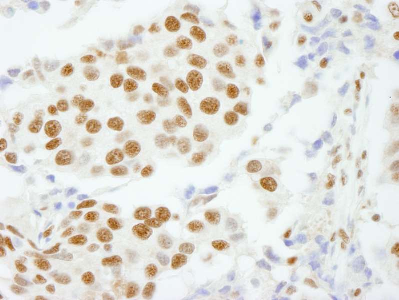 Detection of Human CPSF160 by Immunohistochemistry. Sample: FFPE section of human breast carcinoma. Antibody: Affinity purified rabbit anti-CPSF160 used at a dilution of 1:100.