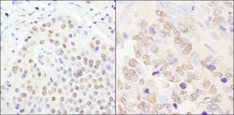 Detection of Human and Mouse CPSF100 by Immunohistochemistry. Sample: FFPE section of human pancreatic islet cell tumor (left) and mouse teratoma (right). Antibody: Affinity purified rabbit anti-CPSF100 used at a dilution of 1:200 (1 ug/ml). Detection: DAB.