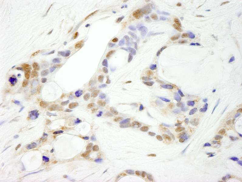 Detection of Human CPSF100 Immunohistochemistry. Sample: FFPE section of human ovarian carcinoma. Antibody: Affinity purified rabbit anti-CPSF100 used at a dilution of 1:250.