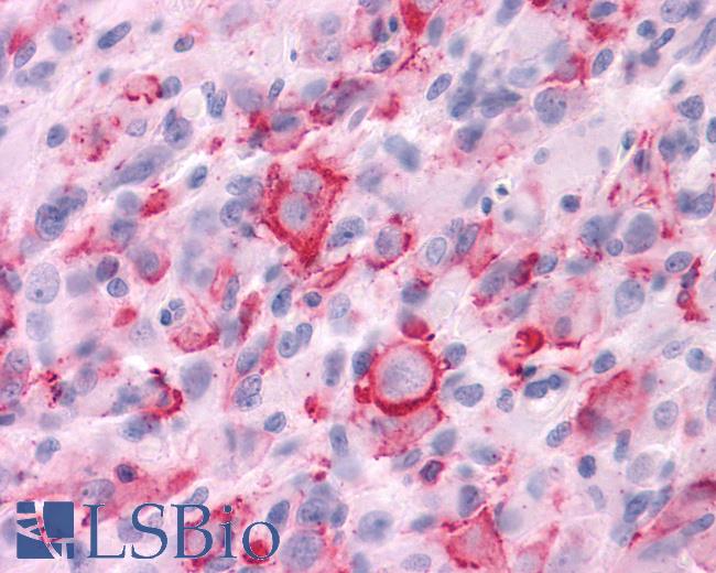 Anti-CHRM3 / M3 antibody IHC of human Brain, Glioblastoma. Immunohistochemistry of formalin-fixed, paraffin-embedded tissue after heat-induced antigen retrieval.